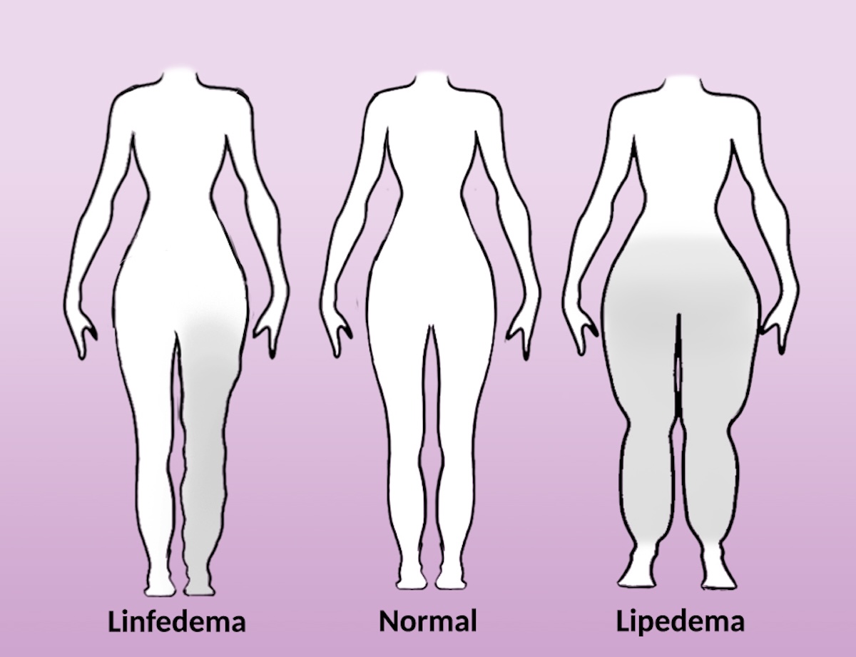 Lipedema y linfedema, dos enfermedades con síntomas parecidos, pero ...
